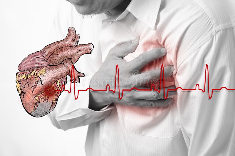 Herzinfarkt und Innere Schläge Cardiogram