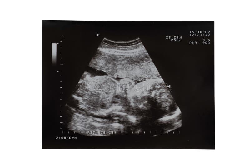 Het Beeld van de Echoscopie van de zwangerschap stock fotografie Het Beeld van de Echoscopie van de zwangerschap stock fotografie