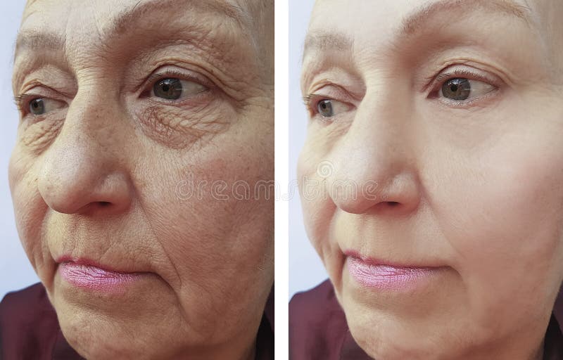 Het contrast van het gezichtsrimpels van het bejaarde before and after procedures royalty-vrije stock fotografie Het contrast van het gezichtsrimpels van het bejaarde before and after procedures royalty-vrije stock fotografie