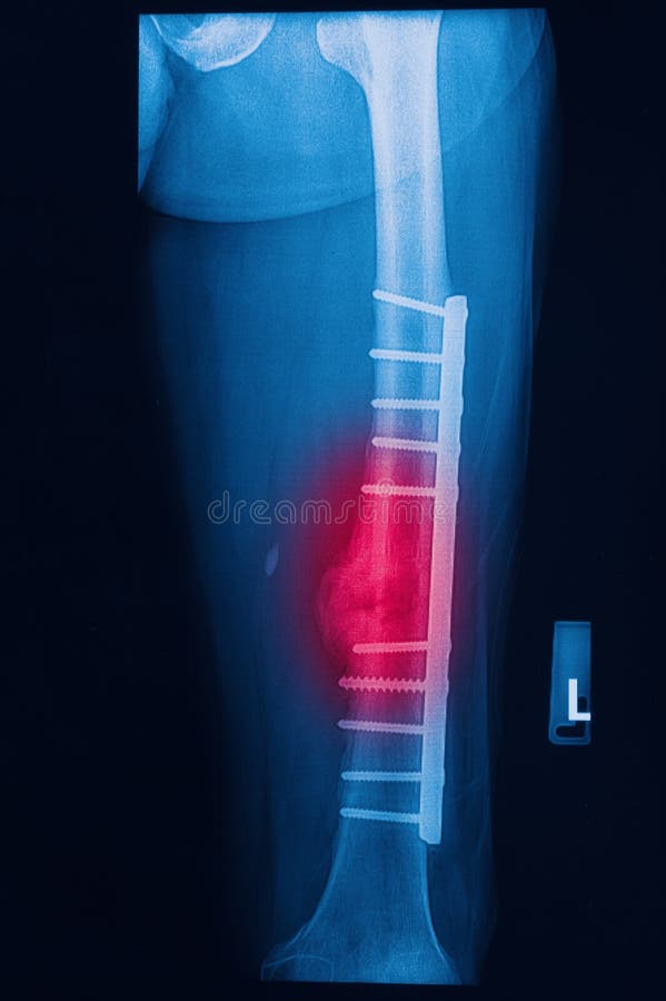 Het gebroken menselijke beeld van dijröntgenstralen met implant stock foto's Het gebroken menselijke beeld van dijröntgenstralen met implant stock foto's