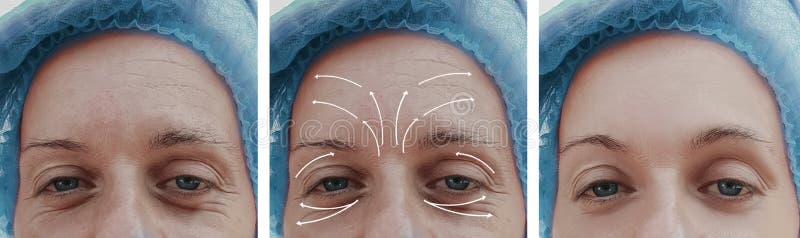 Het gezicht van de vrouwenhuid rimpelt effect de correctie van behandelingsresultaten before and after procedures, pijl royalty-vrije stock foto's Het gezicht van de vrouwenhuid rimpelt effect de correctie van behandelingsresultaten before and after procedures, pijl royalty-vrije stock foto's