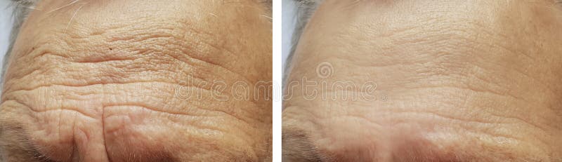 Het gezicht van het voorhoofdrimpels van het gezichtsbejaarde before and after procedures royalty-vrije stock foto's Het gezicht van het voorhoofdrimpels van het gezichtsbejaarde before and after procedures royalty-vrije stock foto's