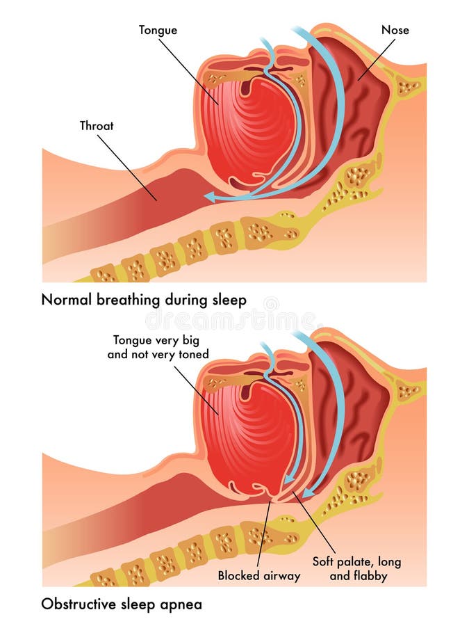 Medical illustration of the consequences of obstructive sleep apnea. Medical illustration of the consequences of obstructive sleep apnea