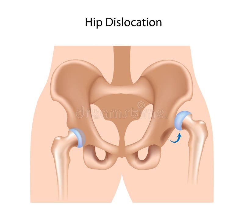Dislocated Stock Illustrations – 92 Dislocated Stock Illustrations, Vectors & Clipart - Dreamstime Dislocated Stock Illustrations – 92 Dislocated Stock Illustrations, Vectors & Clipart - Dreamstime