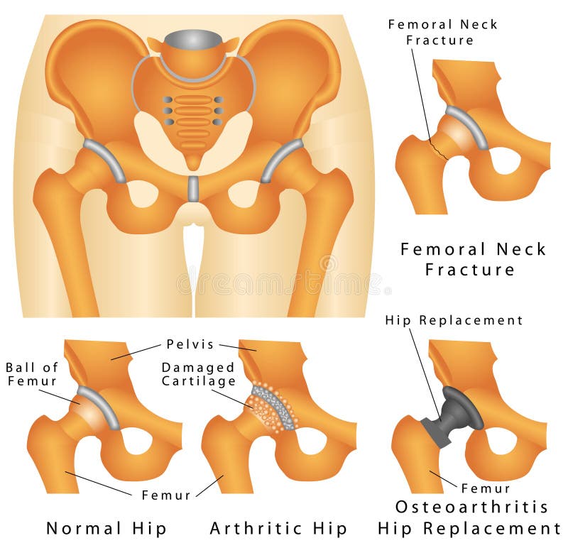Hip joint royalty free illustration Hip joint royalty free illustration