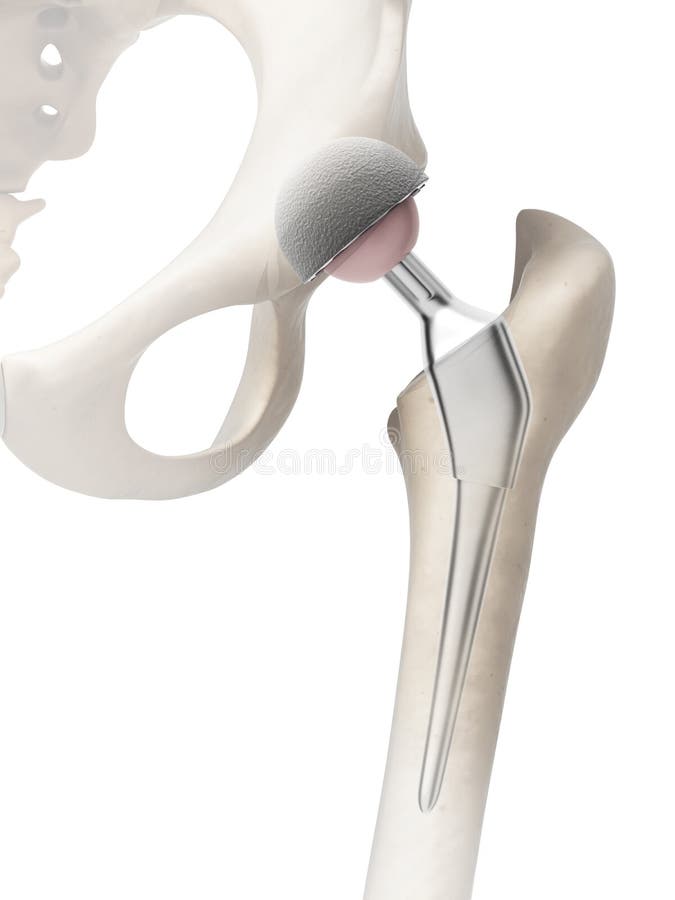 Hip replacement royalty free illustration