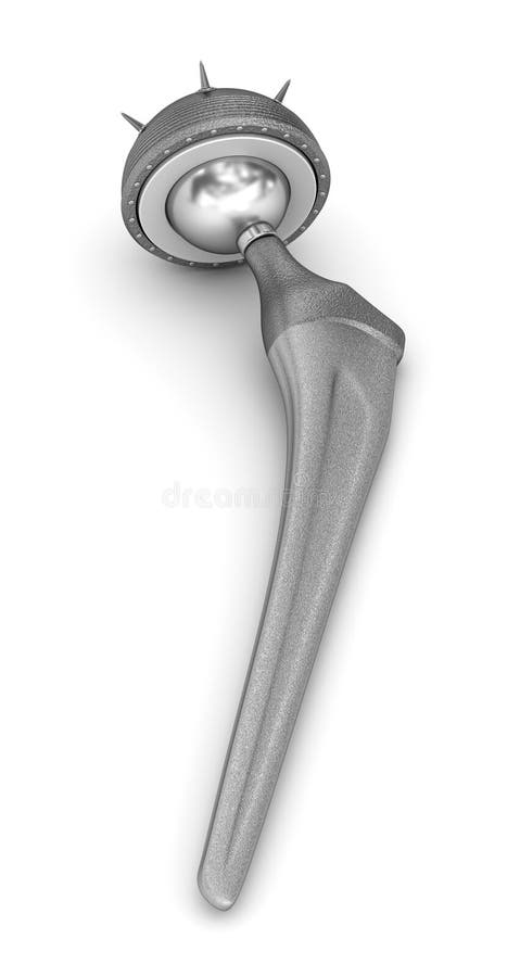 Hip replacement implant. Medically accurate 3D illustration vector illustration Hip replacement implant. Medically accurate 3D illustration vector illustration
