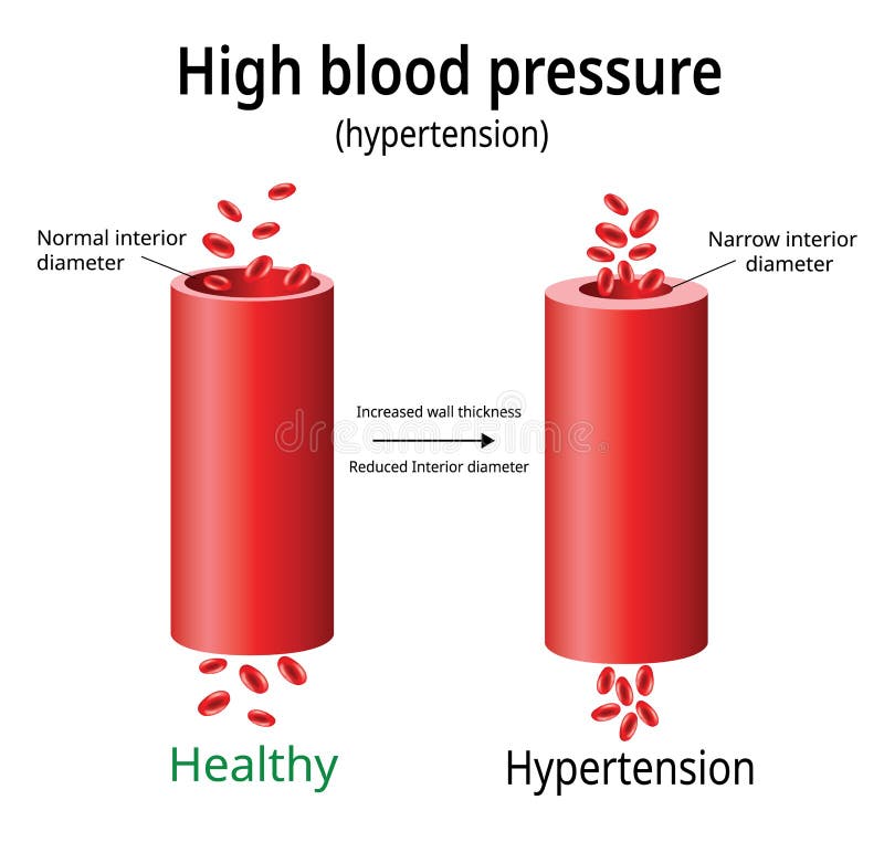 Hypertension, high blood pressure vector, two blood vessels, science and medical use, Vector Illustration. Hypertension, high blood pressure vector, two blood vessels, science and medical use, Vector Illustration