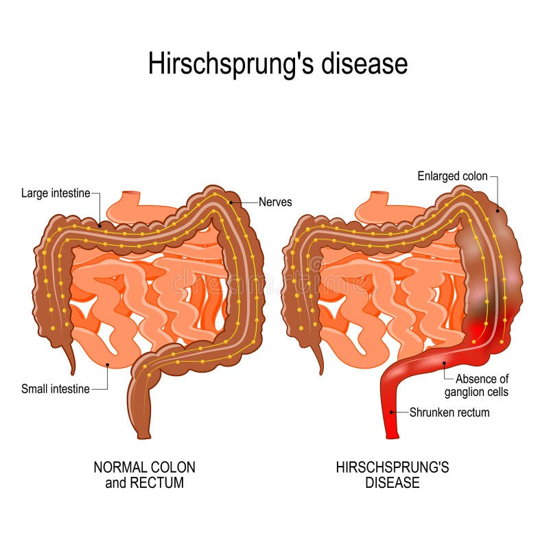 Diagram Of Constipated Bowel Stock Vector - Illustration of tube, mass