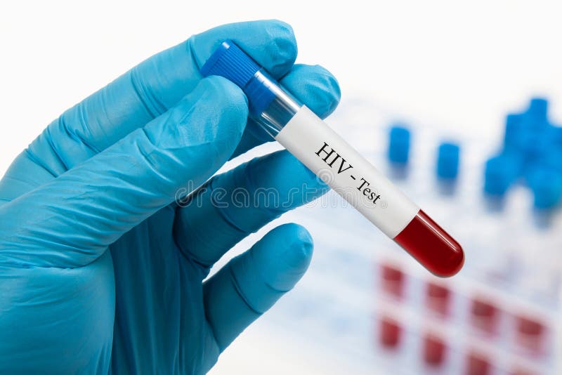 HIV Test royalty-vrije stock afbeeldingen HIV Test royalty-vrije stock afbeeldingen