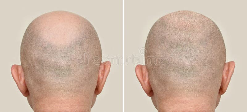 Homens Carecas vs Homens Com Cabelo / Problemas Engraçados Sobre