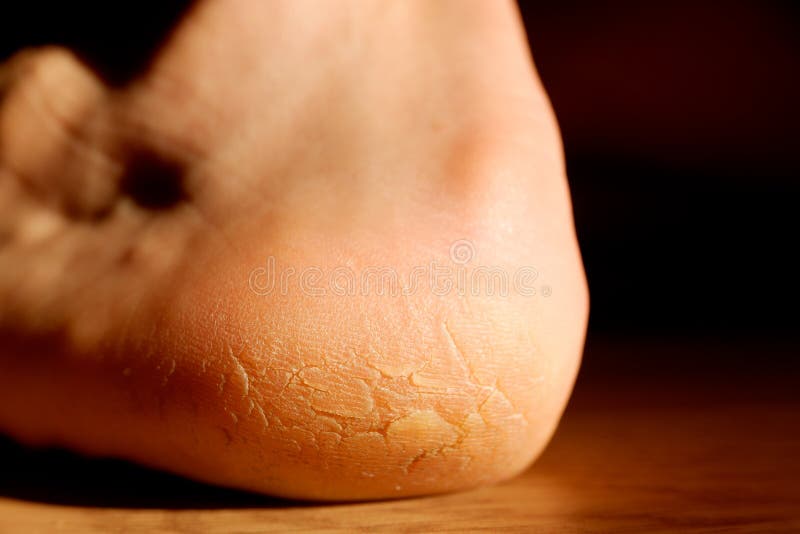 Homem com pele de calcanhar rachada e seca isolada em fundo preto imagens de stock