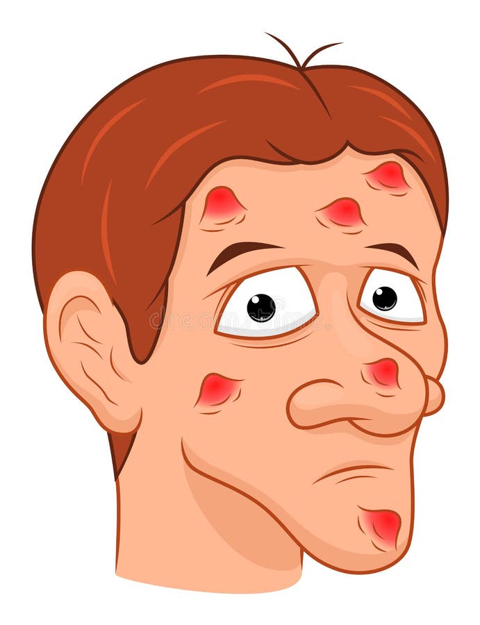 Homem dos desenhos animados com acne ilustração stock Homem dos desenhos animados com acne ilustração stock