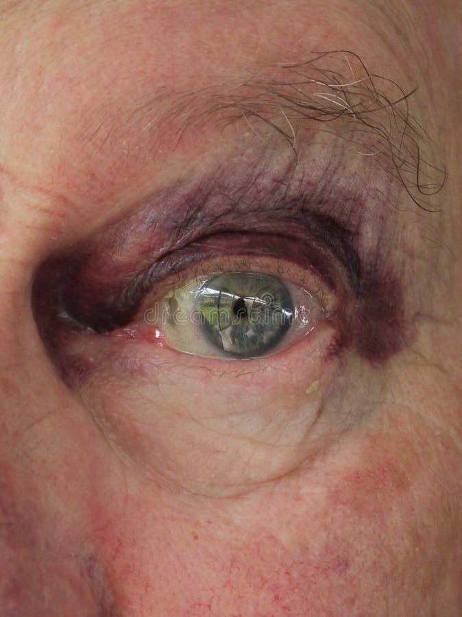 Homem sênior: olho roxo ferido fotos de stock Homem sênior: olho roxo ferido fotos de stock
