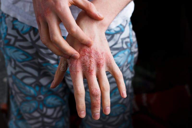 Remoção De Tatuagem Laser Na Mão Das Mulheres Foto de Stock - Imagem de  laser, interior: 214013894