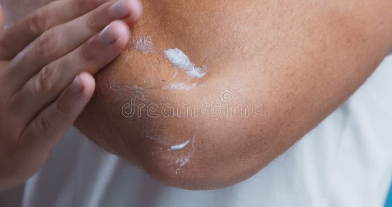 Homme appliquant la pommade sur son coude pour traiter la peau sèche étroitement