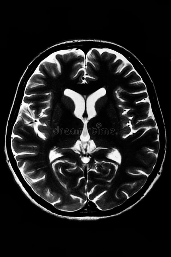 Horizontal section of a human brain - MRI scan