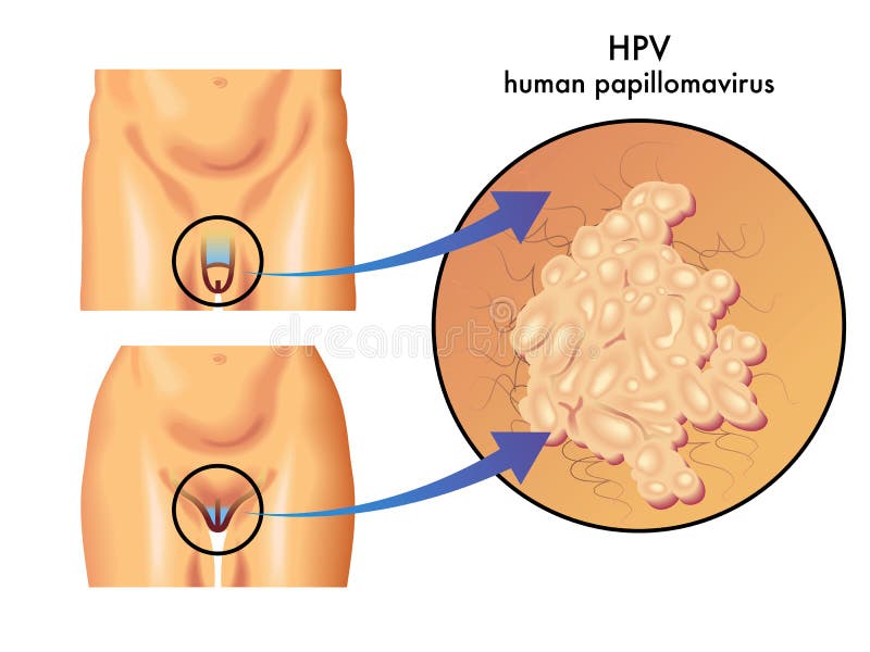 kurkuma en human papillomavirus
