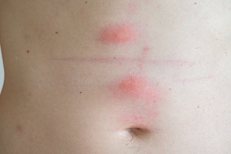 Hud för foten för armen för bröstkorgen för closeupen för loppatuggan, bet kryp buggar royaltyfri bild Hud för foten för armen för bröstkorgen för closeupen för loppatuggan, bet kryp buggar royaltyfri bild