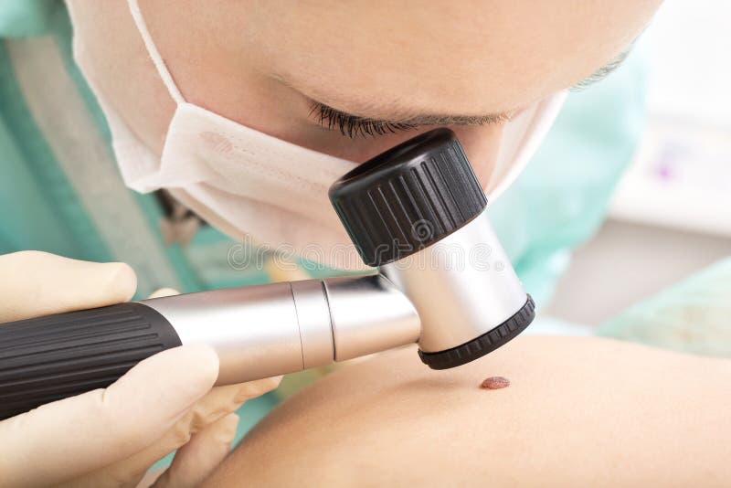 Hudspecialisten undersöker födelsemärket med dermatoscope arkivbild Hudspecialisten undersöker födelsemärket med dermatoscope arkivbild