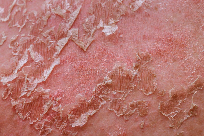 Human Body Develops Irritated Reddened Skin with Flaking Cell Scales