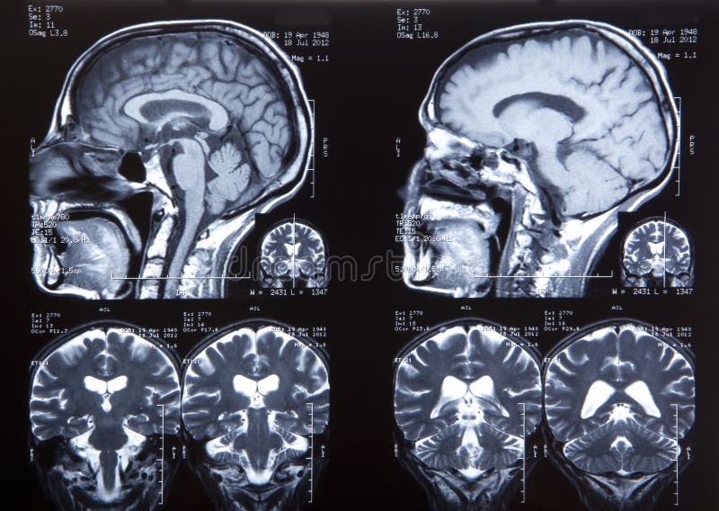 MRI of human brain Macro