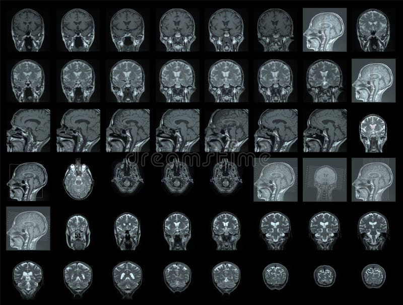 Black MRI of human brain