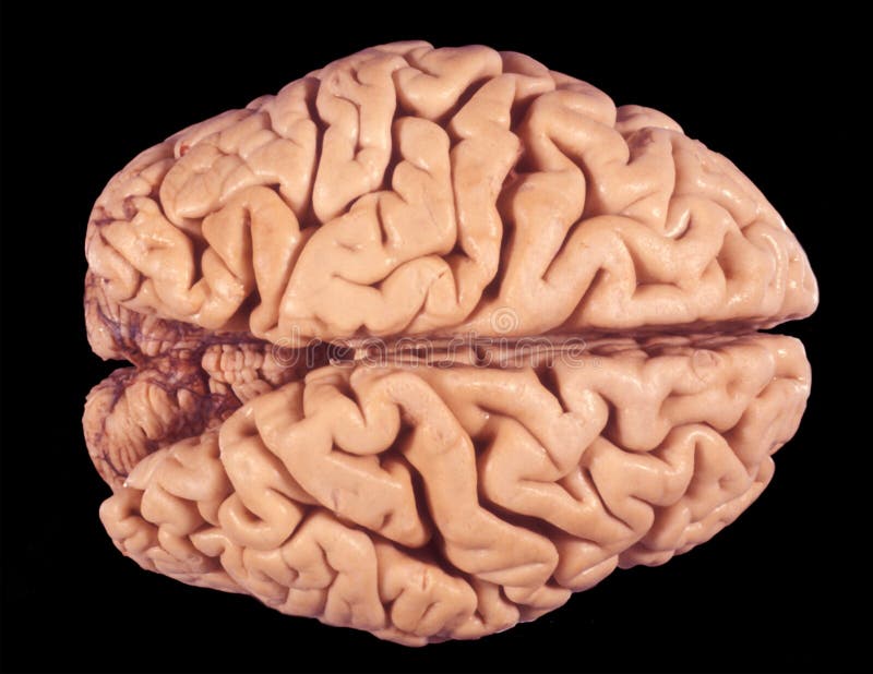 Human Brain. Atrophy of Cerebral Cortex Stock Image - Image of biology,  healthcare: 235494919