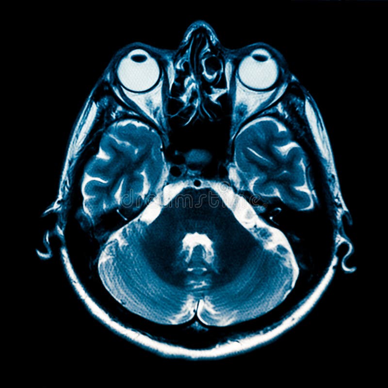 Horizontal section of human brain MRI scan