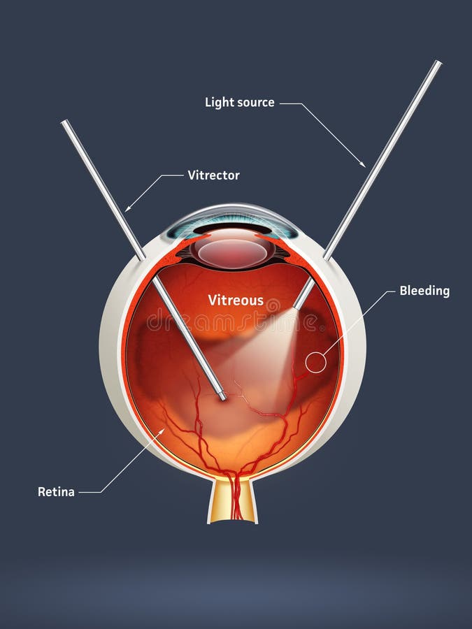Human eye - vitrectomy
