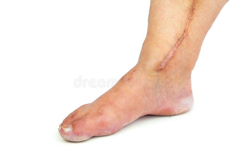 Human leg with postoperative scar of cardiac surgery