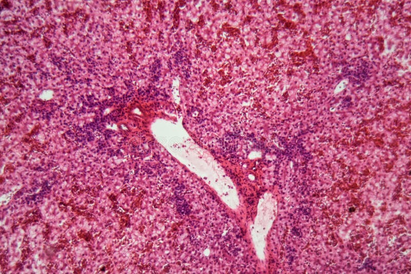 Human Liver Cells with Cancer Stock Photo Image of medicine, death