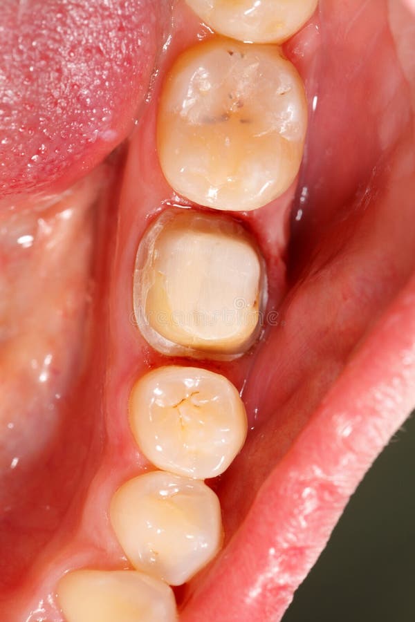 Molar Prepared for Dental Crown Stock Image Image of medical, dentist