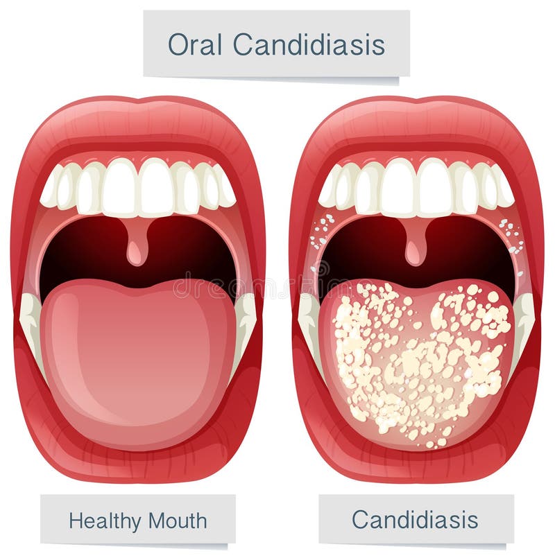 Candidiasis Cartoon