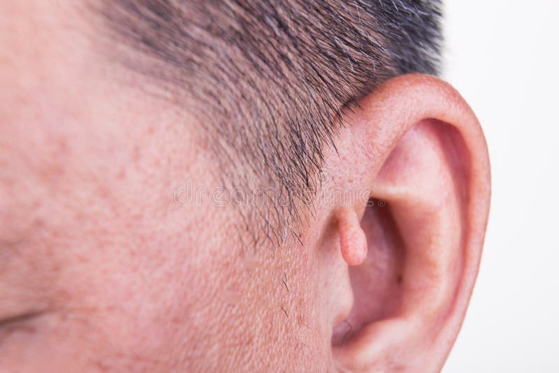 Human mutation with extra growth on ear