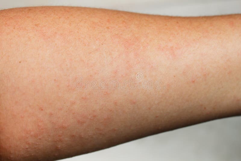 Human Skin, Presenting an Allergic Reaction. Stock Photo Image of