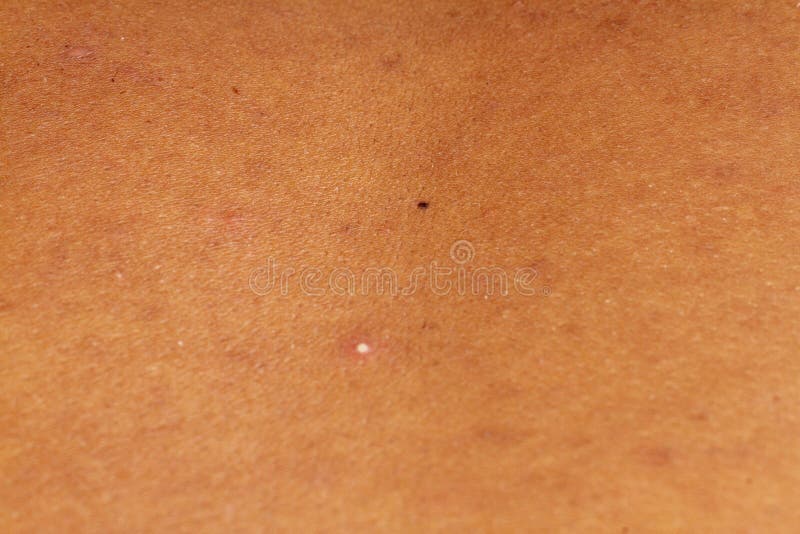 Human Skin Texture Pimples On Skin Micro Photo Stock Image Image Of