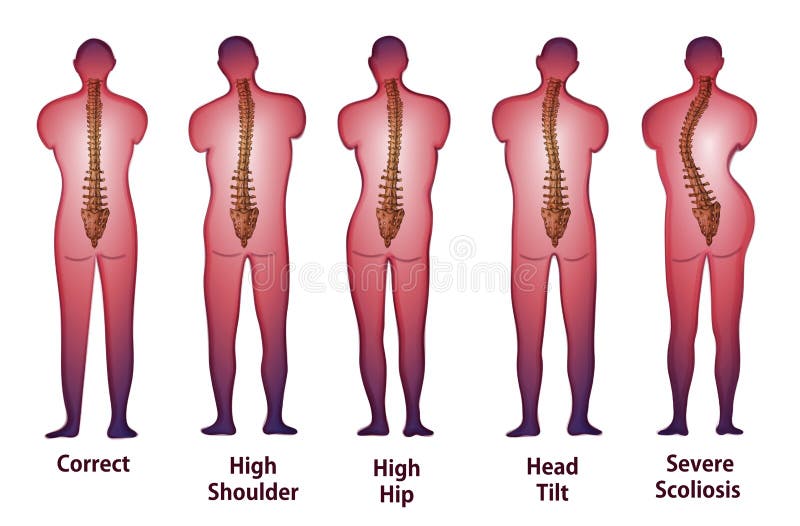 Human Spine Posture Back View Stock Illustration - Illustration of