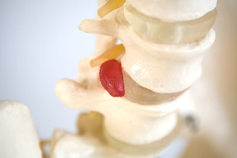 Human Spine showing a Ruptured Disk