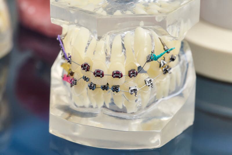 Human Teeth Orthodontic Dental Model with Implants, Dental Braces Stock