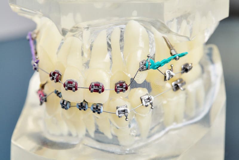 Human teeth orthodontic dental model with implants, dental braces stock images Human teeth orthodontic dental model with implants, dental braces stock images