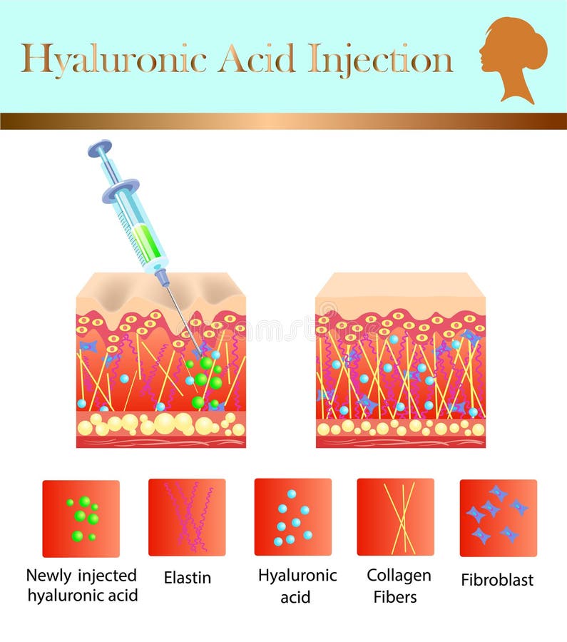 Hyaluronic Acid Injection, before and Affect , Vector Illustration