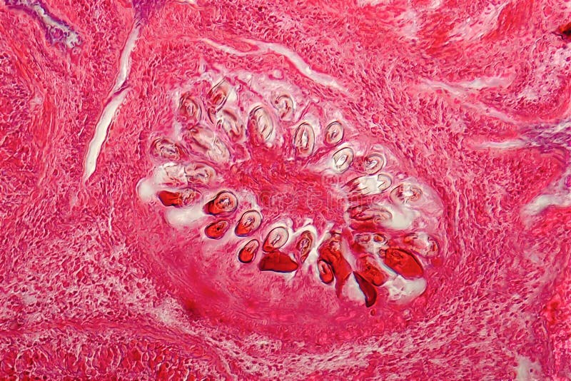 Hydatid Cyst of Liver Caused by Tapeworm Parasite Echinococcus