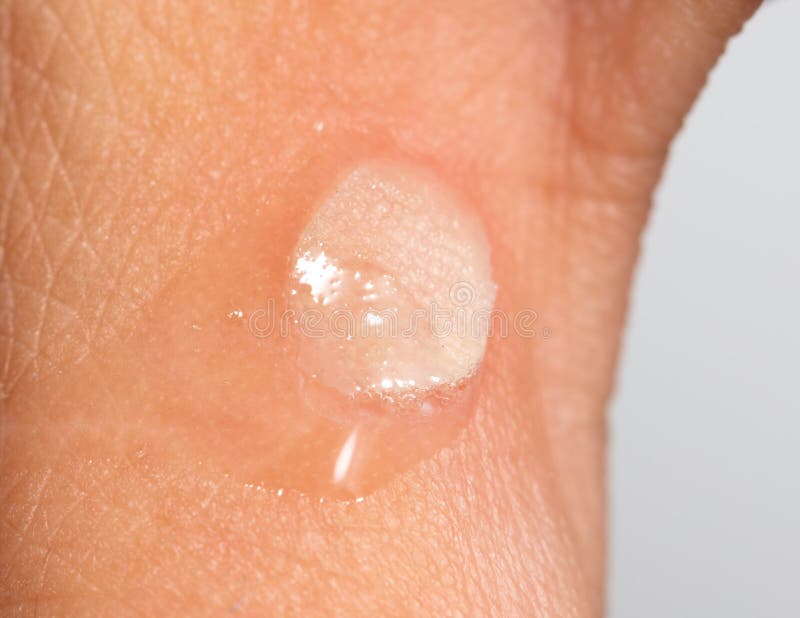 Hydrogen Peroxide Skin Stock Photos Free & RoyaltyFree Stock Photos