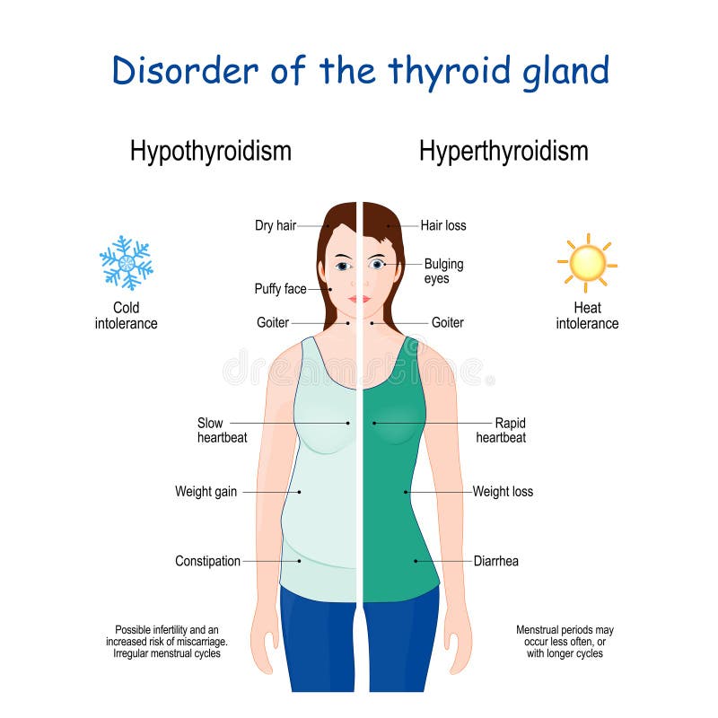 Hyperthyroïdie en hypothyroïdie. vrouwtje met tekenen en symptomen van verschillende schildklierziekten