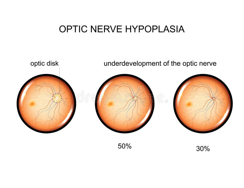 Hypoplasia of the Optic Nerve Stock Vector Illustration of clear