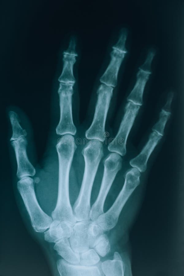 Händerna. riktig, röntgenbild av en hand med fingrar. på läkarens sjukhus.