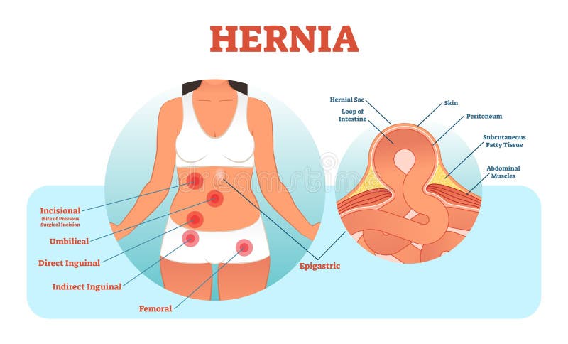 A hérnia datilografa a ilustração do vetor e o seção transversal da ruptura e do intestino do músculo ilustração royalty free A hérnia datilografa a ilustração do vetor e o seção transversal da ruptura e do intestino do músculo ilustração royalty free