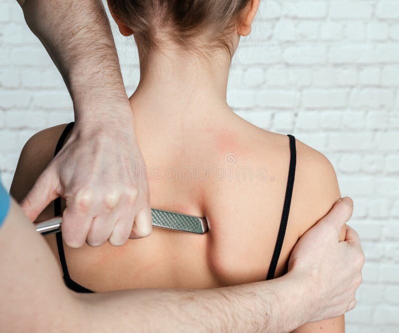 IASTM treatment, girl receiving soft tissue treatment on her neck with stainless steel tool stock photo