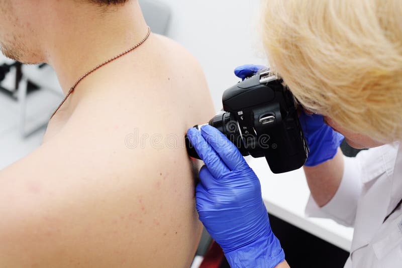 Il dermatologo di medico esamina le voglie e le voglie del paziente con un dermatoscope immagini stock Il dermatologo di medico esamina le voglie e le voglie del paziente con un dermatoscope immagini stock